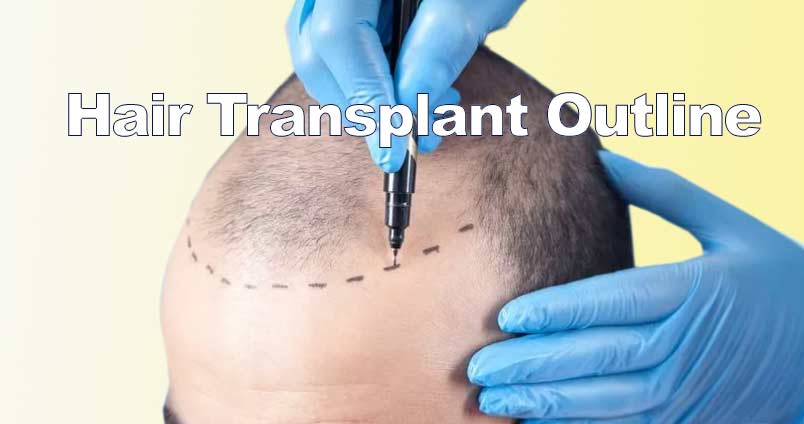 Hair transplant outline