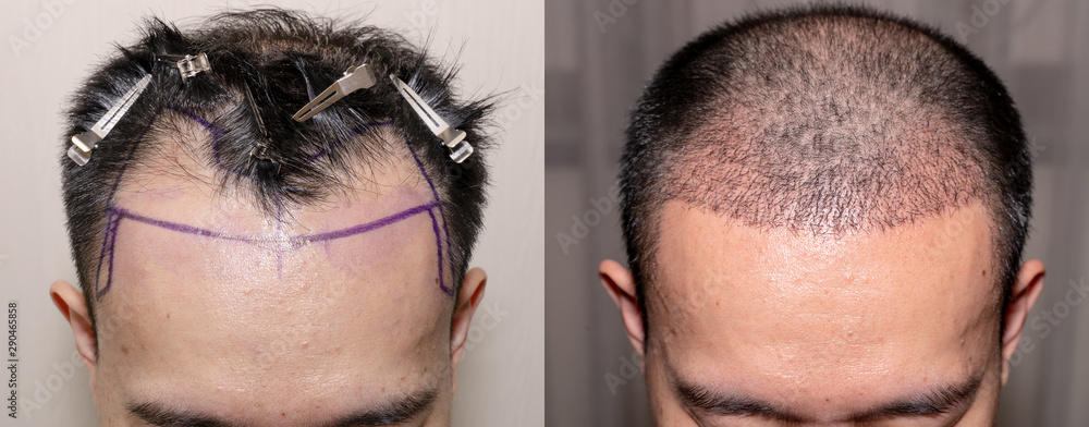 hair transplants for a man showing before and after
