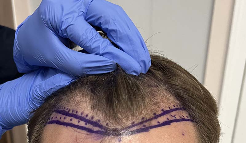 who-invented-hair-transplant